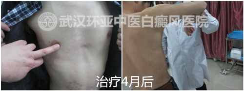 稳定期白癜风9.jpg