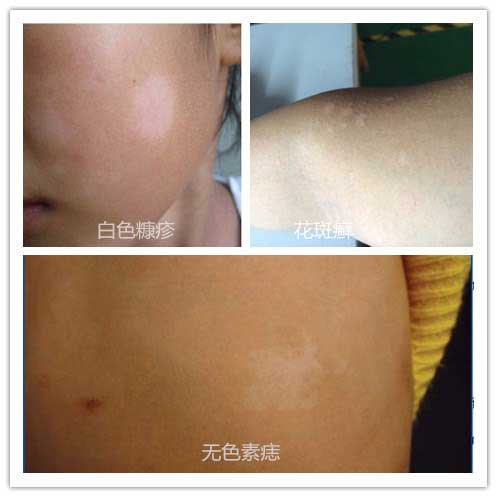 白斑症状1.jpg