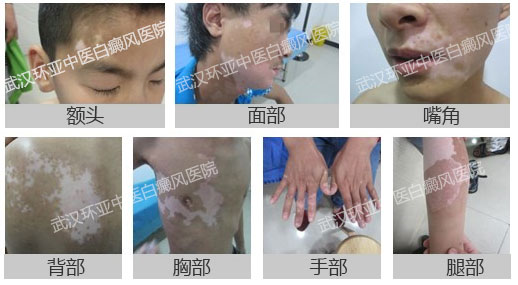 白癜风部位.jpg