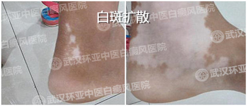 稳定期白癜风1.jpg