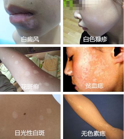 白斑.jpg