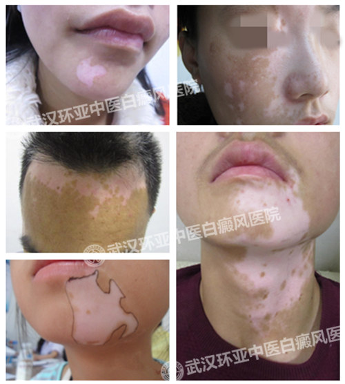 治疗面部白癜风1.jpg