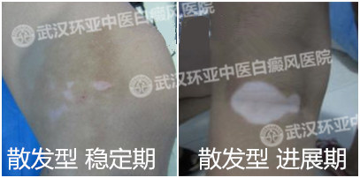 稳定期白癜风2.jpg