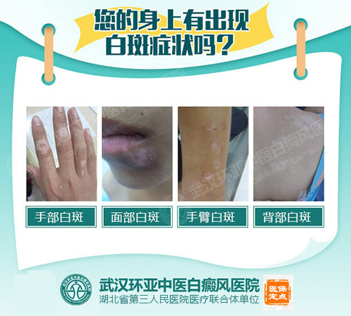 42-身上白斑会发展吗?如何去除白斑.jpg