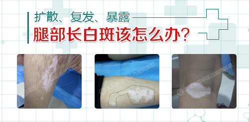 8-被忽视的腿部白斑,该如何应对?.jpg