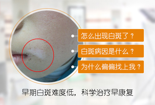 44-出现白斑的病因是什么呢.jpg