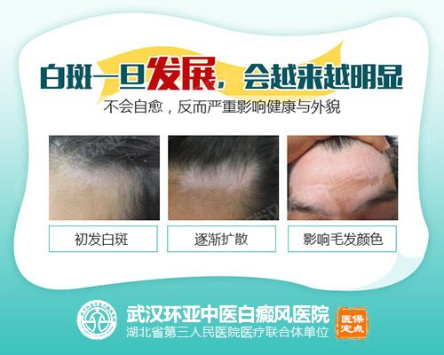 42-身上白斑会发展吗?如何去除白斑-2.jpg